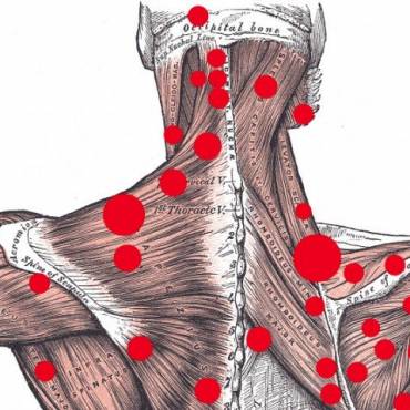 Trigger Points and Treatment Modalities